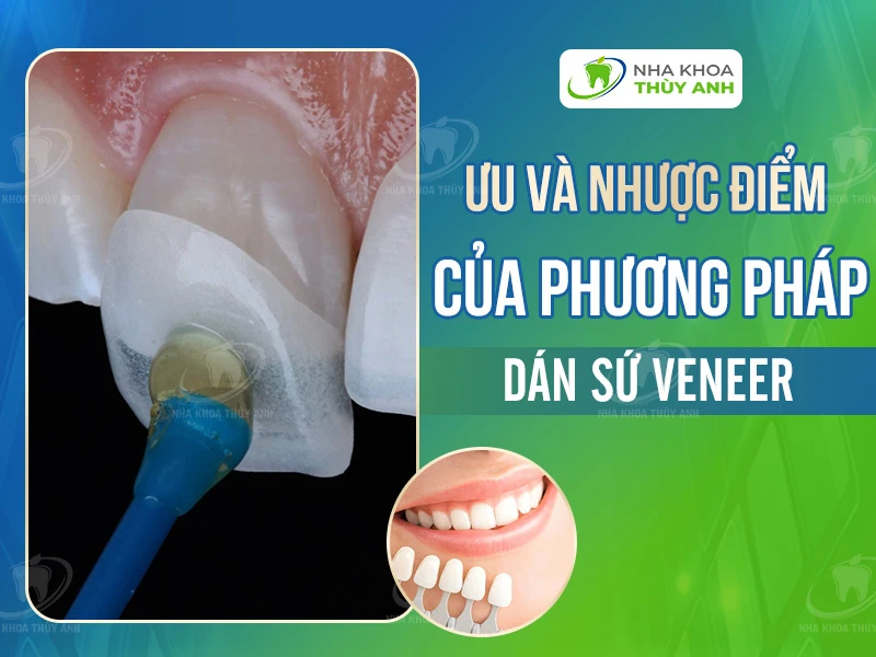 Ưu điểm và nhược điểm của phương pháp dán sứ veneer