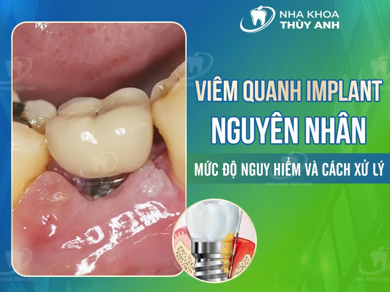 Viêm quanh implant: Nguyên nhân, mức độ nguy hiểm và cách xử lý