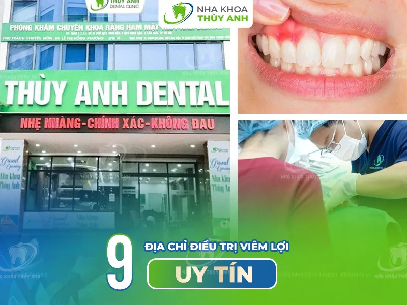 9 địa chỉ điều trị viêm lợi uy tín
