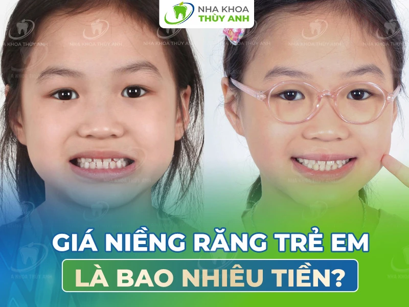 Giá niềng răng trẻ em là bao nhiêu tiền? [Tháng 9.2025]