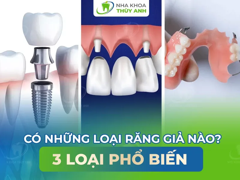 Có những loại răng giả nào? 3 loại phổ biến