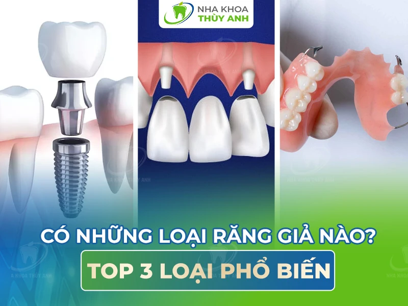 Có những loại răng giả nào? Top 3 loại phổ biến
