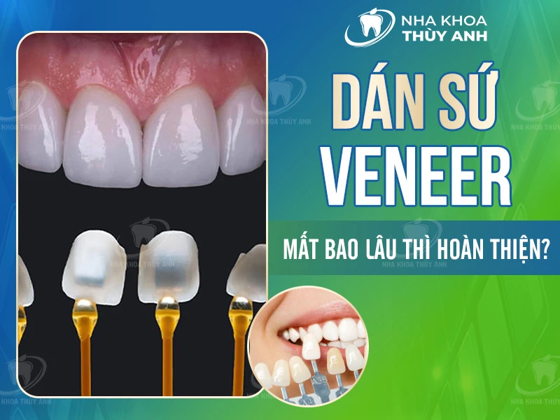 Dán sứ Veneer mất bao lâu thì hoàn thiện?  