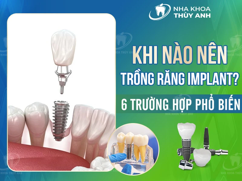 Khi nào nên trồng răng implant? 6 trường hợp phổ biến
