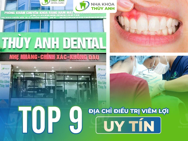 Top 9 địa chỉ điều trị viêm lợi uy tín
