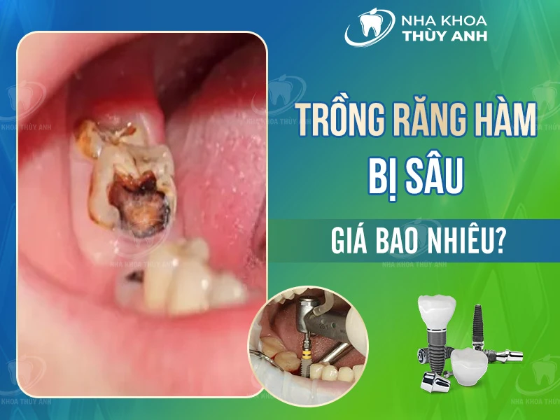 Trồng răng hàm bị sâu giá bao nhiêu?