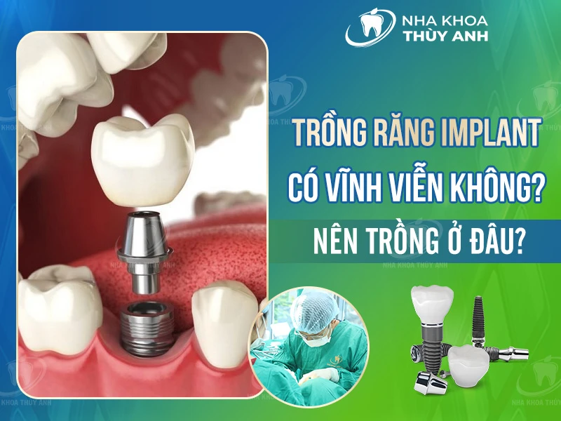Trồng răng implant có vĩnh viễn không? Nên trồng ở đâu?