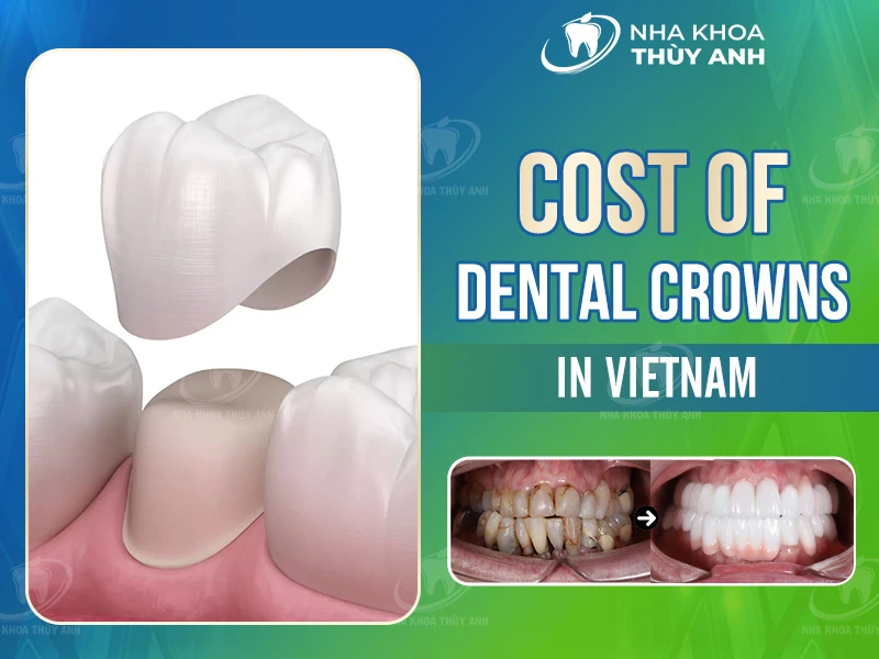 Cost of Dental Crowns in Vietnam