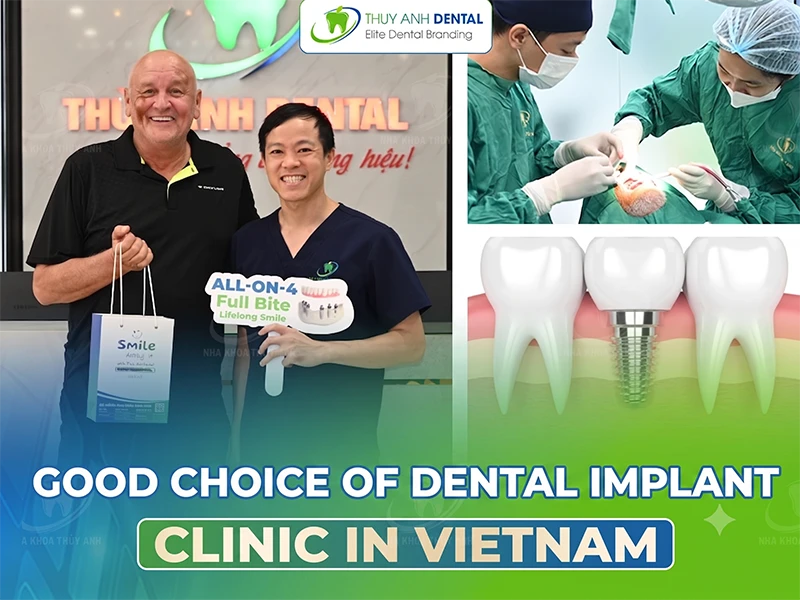 Good choice Dental Implant Clinic in Vietnam