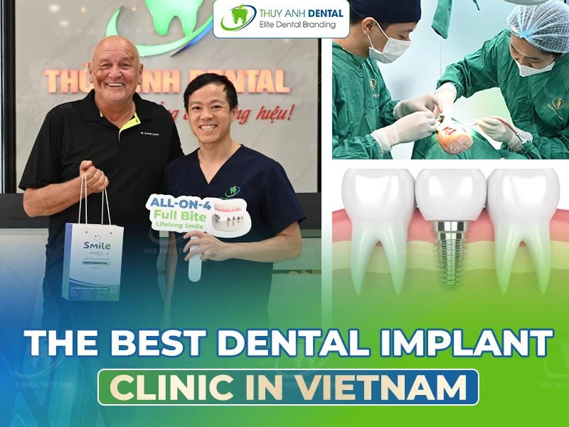The Best Dental Implant Clinic in Vietnam