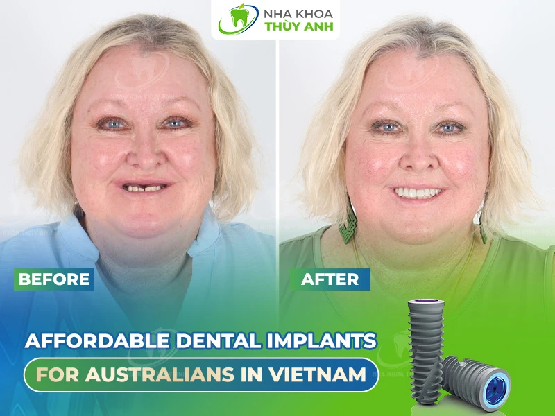 Affordable dental implants for Australians in Vietnam