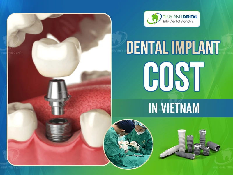 Dental Implant Cost in Vietnam