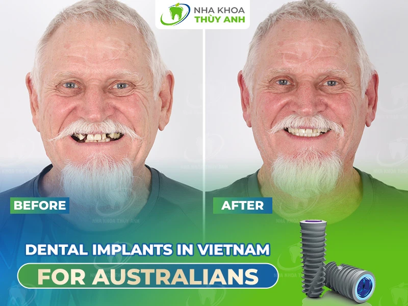 Dental Implants in Vietnam for Australians
