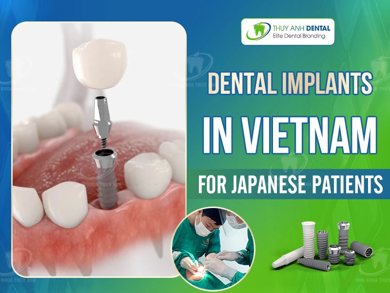 Dental Implants in Vietnam for Japanese Patients