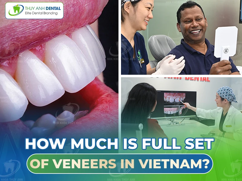 How much is a full set of veneers in Vietnam?