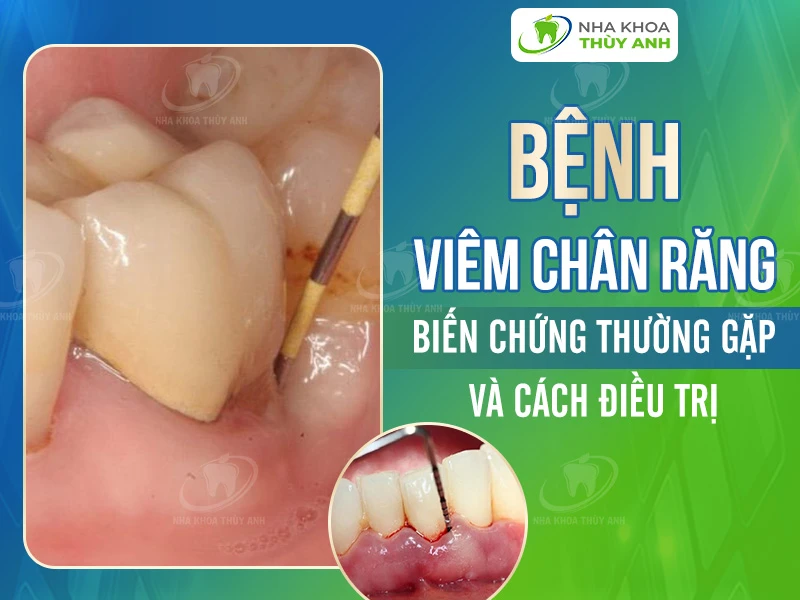 Bệnh viêm chân răng: Biến chứng thường gặp và cách điều trị