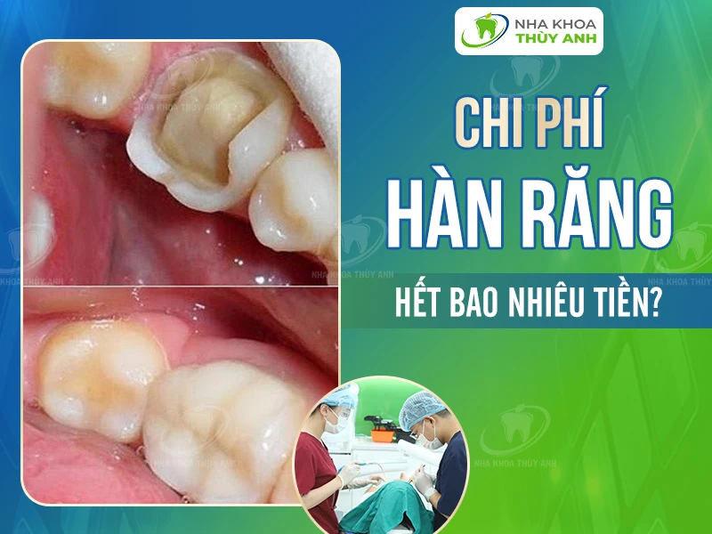 Chi phí hàn răng hết bao nhiêu tiền? Tháng 1.2026