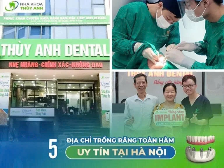 5 địa chỉ trồng răng toàn hàm uy tín tại Hà Nội