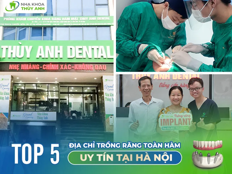 5 địa chỉ trồng răng toàn hàm uy tín tại Hà Nội