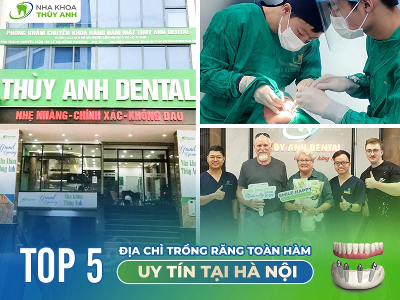 5 địa chỉ trồng răng toàn hàm uy tín tại Hà Nội