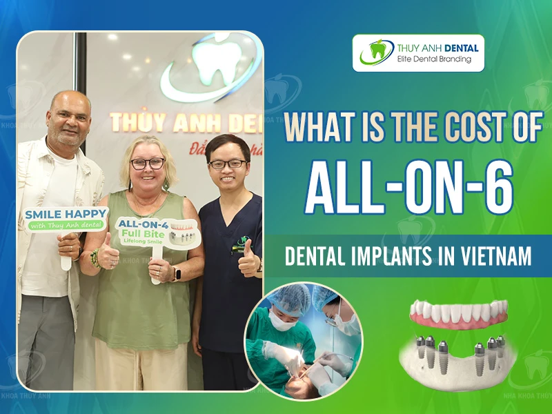 What is the cost of All-on-6 dental implants in Vietnam?