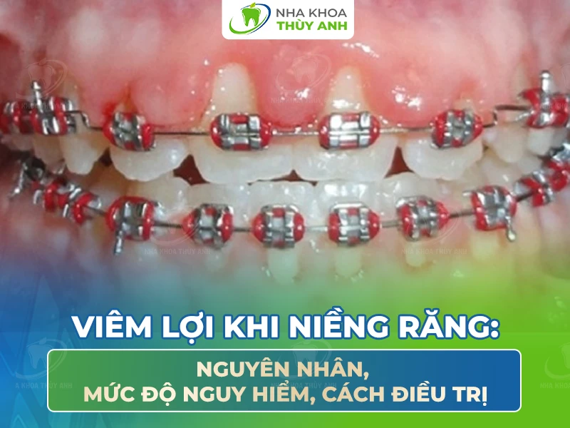 Viêm lợi khi niềng răng: Nguyên nhân, mức độ nguy hiểm, cách điều trị