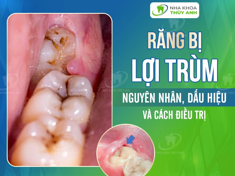 Răng bị lợi trùm: Nguyên nhân, dấu hiệu và cách điều trị