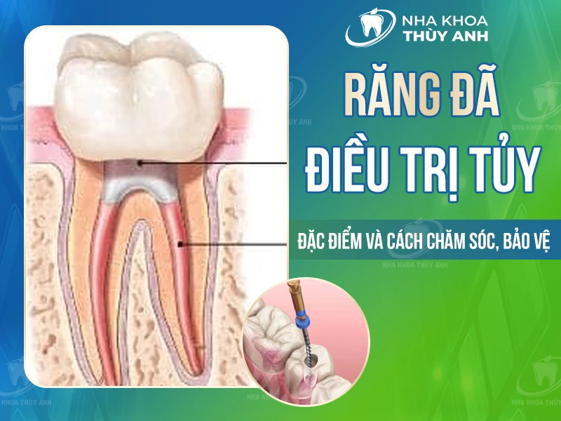 Răng đã điều trị tủy: Đặc điểm và cách chăm sóc, bảo vệ