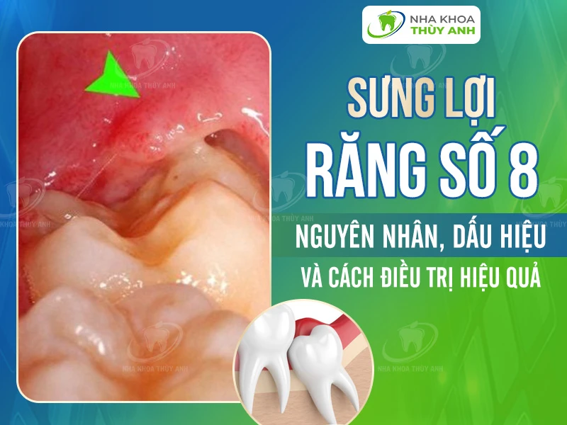 Sưng lợi răng số 8: Nguyên nhân, dấu hiệu và cách điều trị hiệu quả