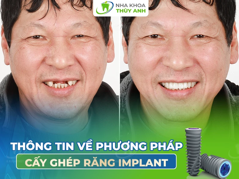 Thông tin về phương pháp cấy ghép răng implant
