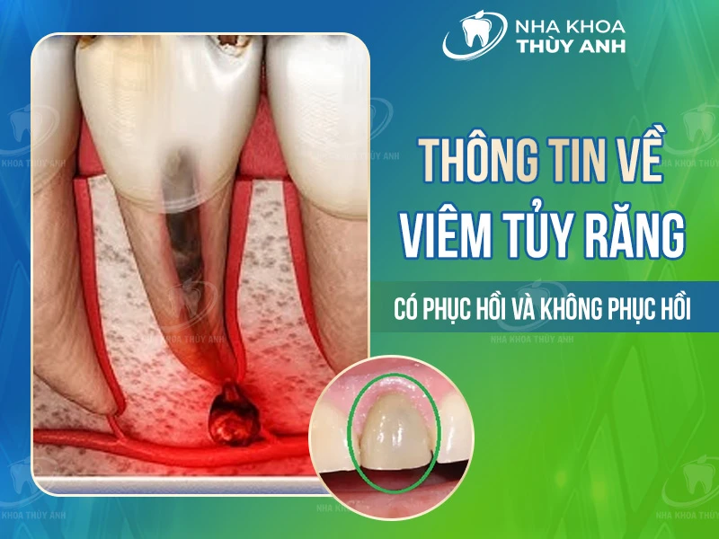 Thông tin về viêm tủy răng có phục hồi và không phục hồi