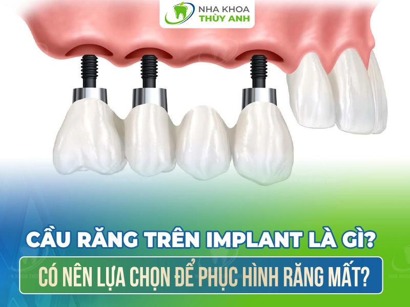 Cầu răng trên Implant là gì? Có nên lựa chọn để phục hình răng mất?