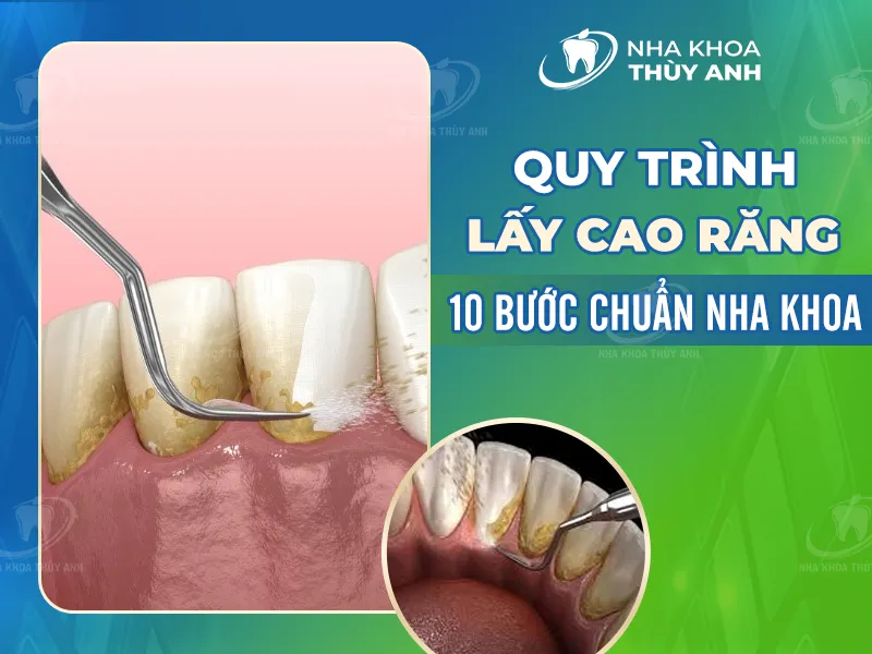 Quy trình lấy cao răng 10 bước chuẩn y khoa 