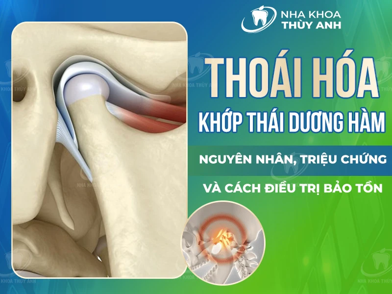 Thoái hóa khớp thái dương hàm: Nguyên nhân, triệu chứng và cách điều trị bảo tồn