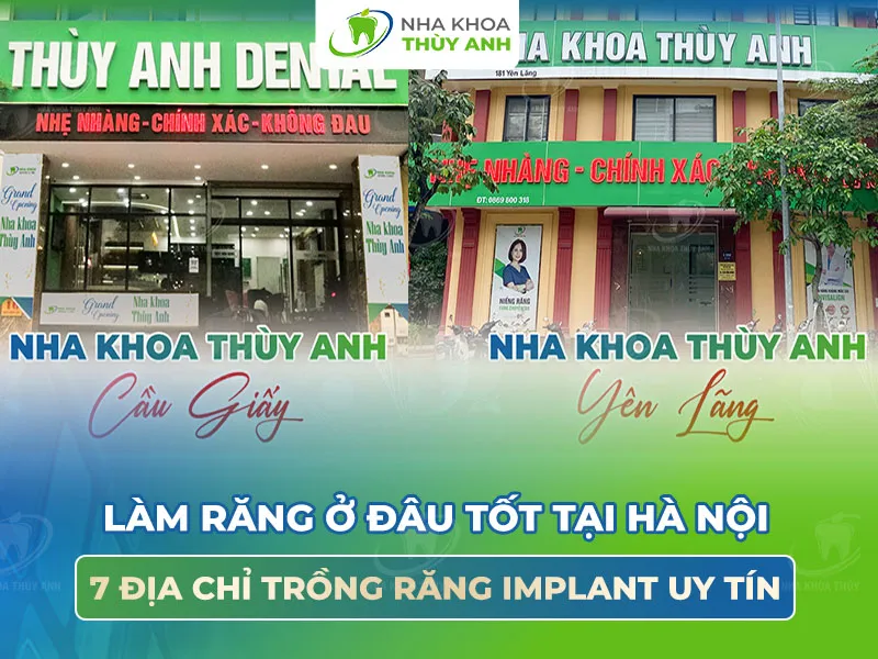Làm răng ở đâu tốt tại Hà Nội? 7 địa chỉ trồng răng implant uy tín