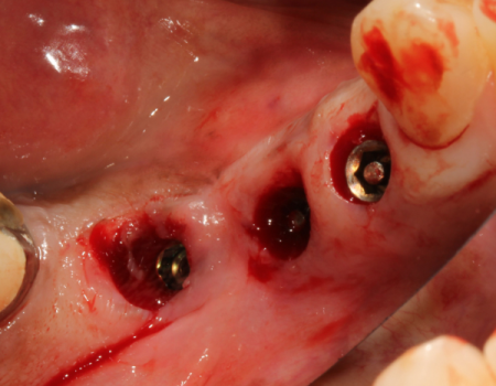 bien-chung-gay-abutment bien-chung-gay-abutment