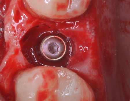 bien-chung-implant all-on -4 bien-chung-implant all-on -4