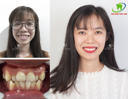 Nên chọn niềng răng invisalign hay mắc cài 5 Nên chọn niềng răng invisalign hay mắc cài 5