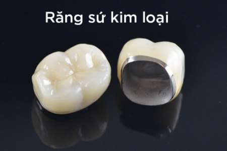  Răng sứ kim loại có tính chịu lực cao 