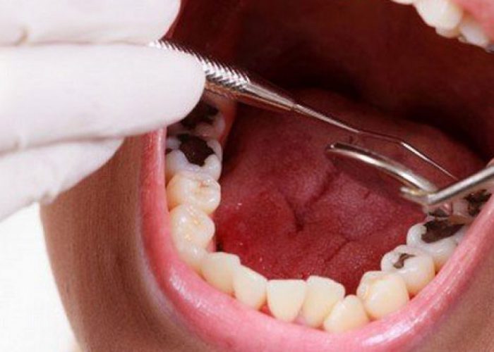 Có nên bọc răng sứ cho răng hàm bị sâu không? Chi phí là bao nhiêu ...