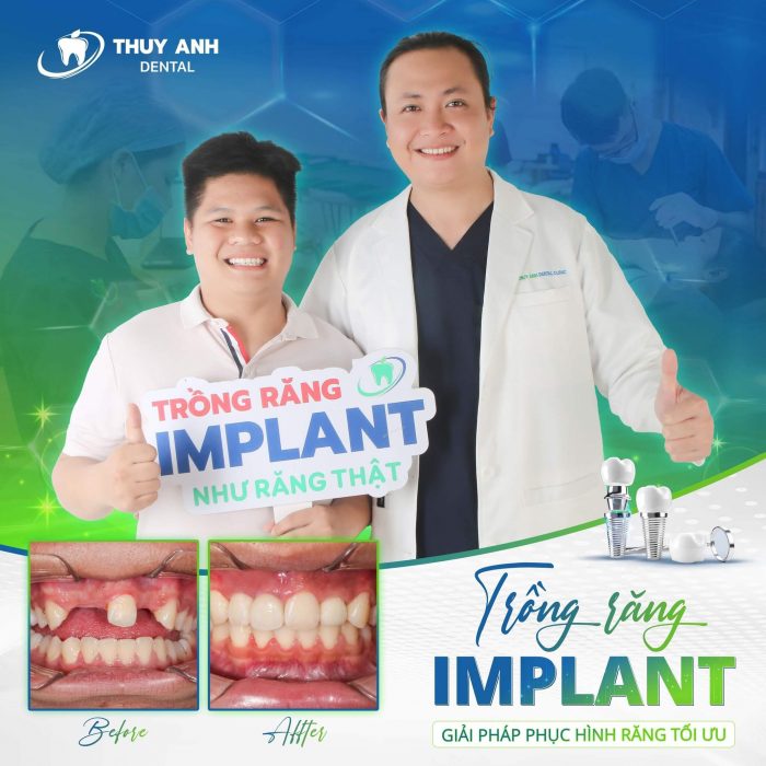 cau-tao-cua-rang-implant-2 (1) cau-tao-cua-rang-implant-2 (1)