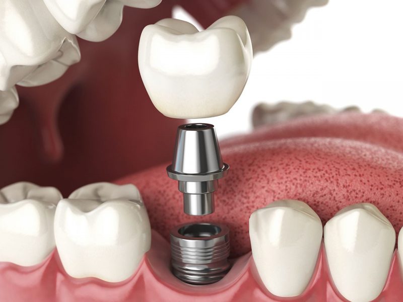 cay-ghep-implant-sau-nho-rang-bao-lau-1 cay-ghep-implant-sau-nho-rang-bao-lau-1
