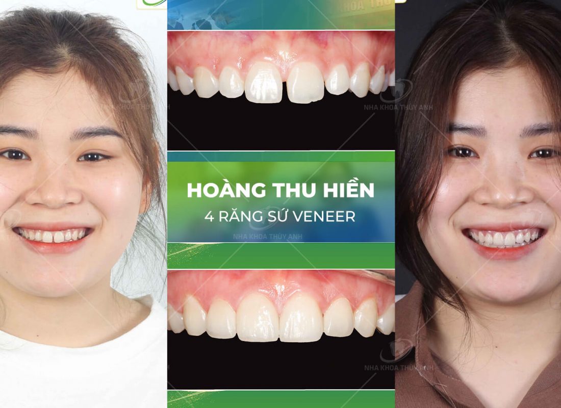 dan-su-veneer-hinh-anh- 8 dan-su-veneer-hinh-anh- 8