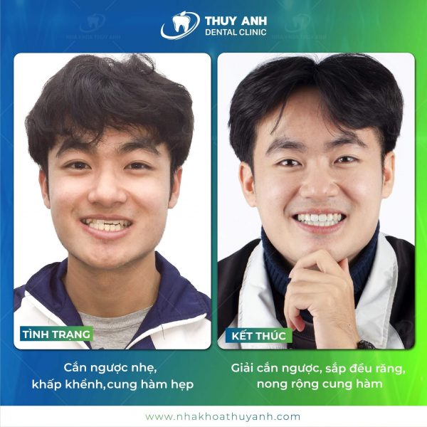 gia-nieng-rang-mom -1 (1) gia-nieng-rang-mom -1 (1)