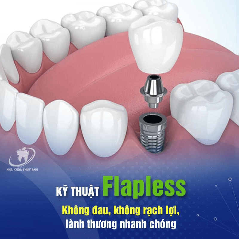 implant-bi-lung-lay-5 implant-bi-lung-lay-5
