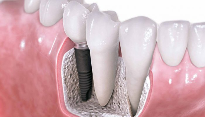 implant-dao-thai-1 implant-dao-thai-1