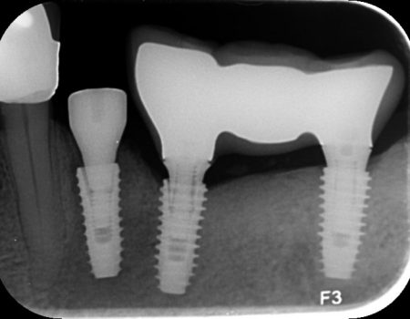 phuc-hinh-lien-hay-roi-tren-implant phuc-hinh-lien-hay-roi-tren-implant