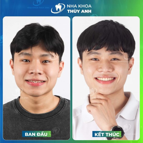 khop-can-nguoc-nhe-2 (1) khop-can-nguoc-nhe-2 (1)