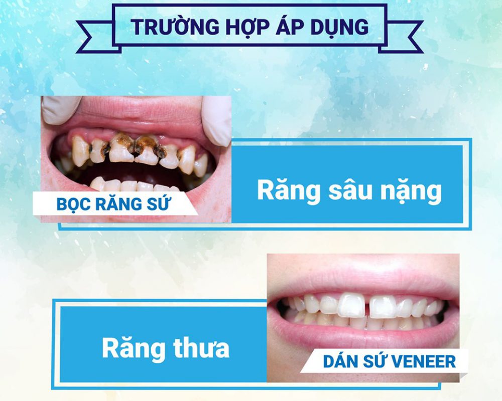 nen-dan-rang-su-hay-boc-rang-su-1 nen-dan-rang-su-hay-boc-rang-su-1