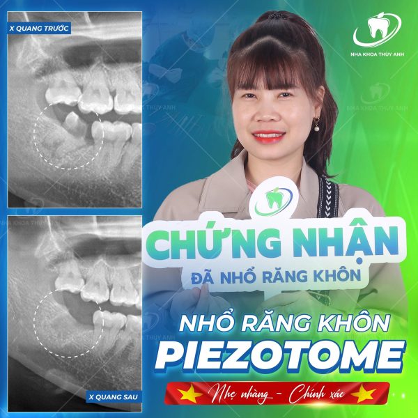 nho-rang-khon-1